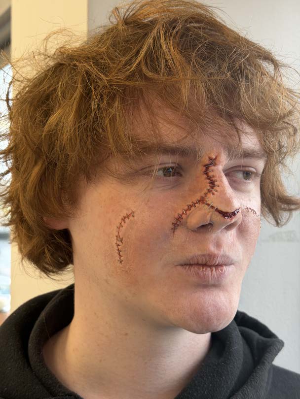 Applied trauma prosthetic on a model's cheek with sutures, blended edges and alcohol-activated colouring.