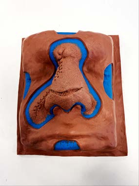 The completed prosthetic mould with keys and dam walls before casting.